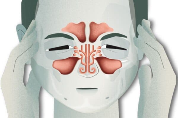 Các bệnh lý mũi xoang không được điều trị kịp thời có thể làm tăng nguy cơ xuất hiện polyp