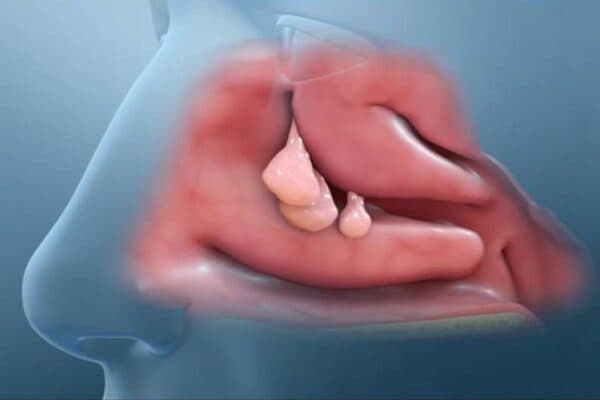 Polyp mũi là một dạng u lành tính, khu trú ở hốc mũi hoặc xoang mũi