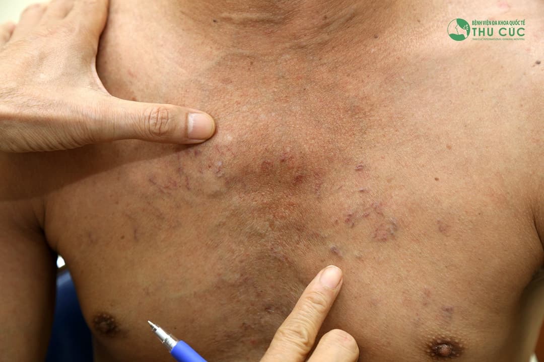 phat-hien-nhiem-au-trung-san-lon-do-an-tiet-canh