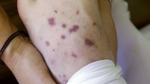 . Các vết ban đỏ nổi ngoài da trong bệnh viêm não mô cầu thường có màu tím thẫm hoặc to bằng đầu đũa hoặc mảng lớn hơn. 