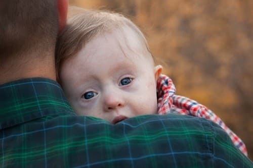 Hội chứng Down là một trong những dị tật bẩm sinh thường gặp.