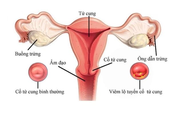 Cổ tử cung cao và những ảnh hưởng tới khả năng mang thai ở nữ giới