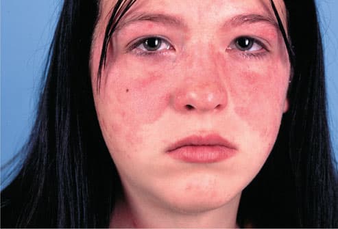Ban cánh bướm ở mặt là một dấu hiệu điển hình của bệnh lupus ban đỏ hệ thống