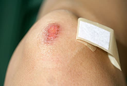 Miếng băng sẽ giúp bảo vệ phần bị thương khỏi bị cọ xát với quần áo bẩn và vi khuẩn, giúp vết thương nhanh chóng lành lặn.