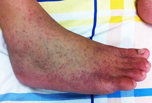 Bênh nhân nhiễm vi rút chikungunya có các triệu chứng như sốt cao đột ngột, đau nhức dữ dội các khớp cổ tay, bàn chân và bàn chân làm cho bệnh nhân không thể đứng thẳng lên được