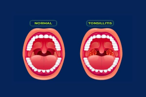 Viêm amidan mạn tính là bệnh lý nguy hiểm, đe doạ sức khoẻ và tính mạng của người bệnh