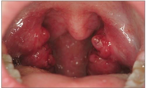 Khi bị viêm amidan, amidan sẽ sưng, đỏ...và gây nhiều phiền toái tới sức khỏe