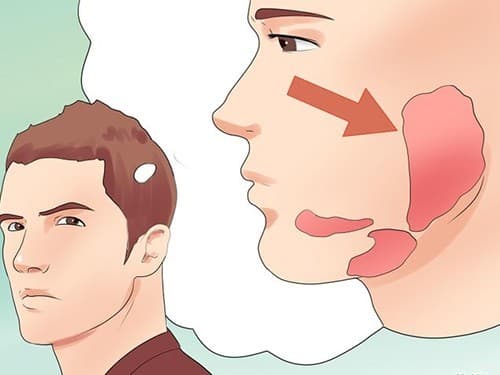 benh-quai-bi-kieng-gi