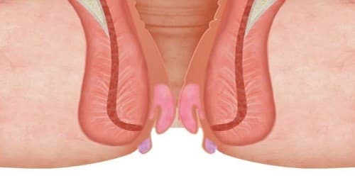 Khi bệnh tiến triển nghiêm trọng, búi trĩ càng ngày càng sưng to và sa ra ngoài nhiều, dùng tay cũng không thể đẩy búi trĩ co trở lại.