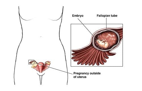 Các biểu hiện chửa ngoài dạ con thường xuất hiện giữa tuần thứ 4 và thứ 12 của thai kỳ. 