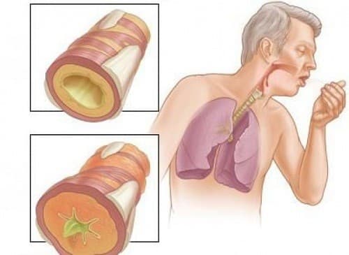 Viêm thanh quản là tình trạng dây thanh trong họng bị viêm và bị kích thích trở nên sưng, đồng thời tiếng nói bị biến dạng