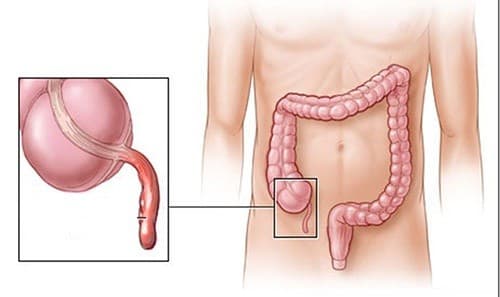 nhung-dau-hieu-dau-ruot-thua1