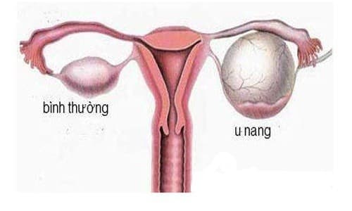 U nang buồng trứng là hiện tượng trên buồng trứng của nữ giới xuất hiện một khối u phát triển bất thường. Khi khối u to cần