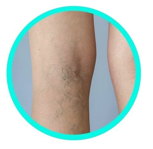 Siêu âm mạch máu sử dụng sóng âm để kiểm tra và đánh giá hệ thống tuần hoàn của cơ thể, xác định tắc nghẽn và phát hiện vị trí của các cục máu đông nếu có. 