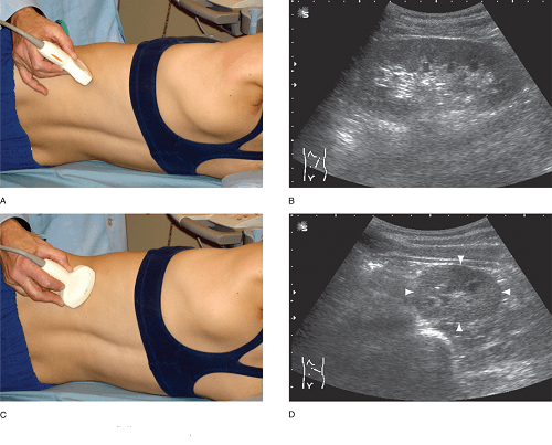  Siêu âm thận được xem là 