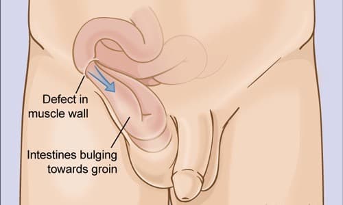 Thoát vị bẹn thường gặp ở nam nhiều hơn nữ do bẩm sinh hoặc mắc phải khi trưởng thành