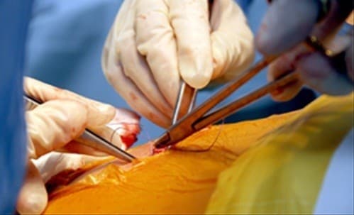 Mổ thoát vị bẹn là phương pháp điều trị triệt để hiện nay giúp cải thiện nhanh chóng tình trạng bệnh