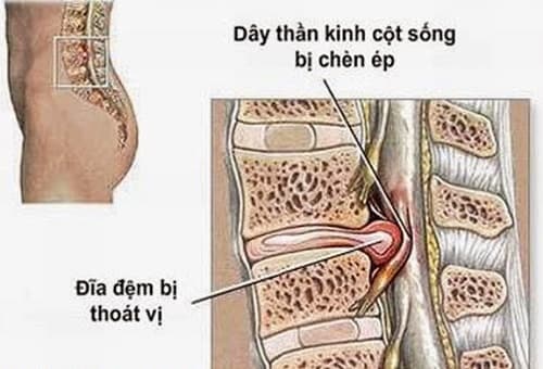 Thói quen sinh hoạt không hợp lý cũng là nguyên nhân gây thoát vị đĩa đệm