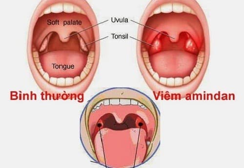 Viêm amidan có thể xảy ra ở mọi lứa tuổi và gây không ít phiền toái tới sức khỏe người bệnh.
