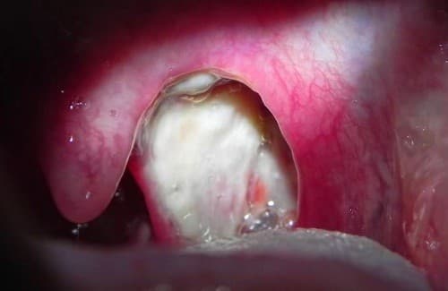 Viêm amidan hốc mủ Chất bã đậu tiết ra