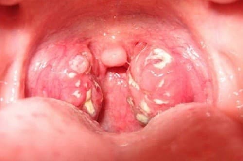 Bệnh viêm amidan hốc mủ: Triệu chứng và cách điều trị