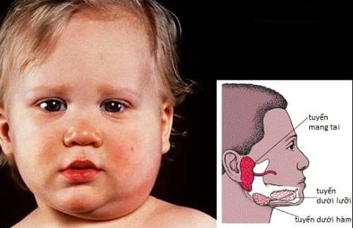 Bệnh quai bị có thể gây biến chứng viêm tinh hoàn, viêm màng não...nguy hiểm tới sức khỏe của trẻ