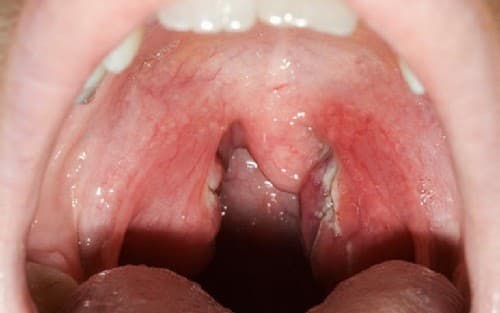 cach-chua-viem-amidan-man-tinh