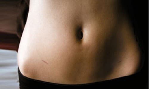 Cắt tử cung có ảnh hưởng gì?sức khỏe và chất lượng cuộc sống