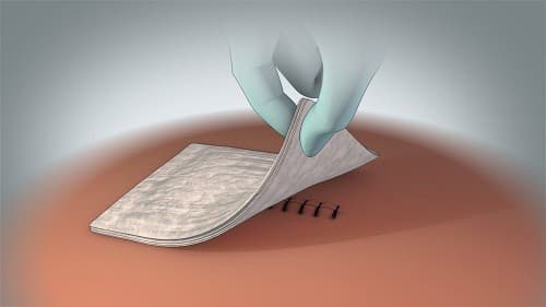 Theo dõi vết mổ là một điều cần thiết khi chăm sóc sau mổ rò hậu môn