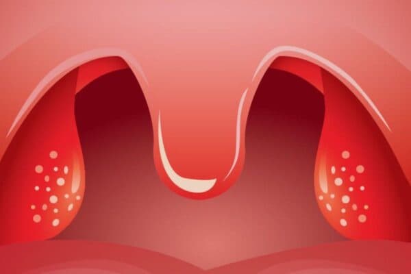 Viêm nhiễm tái diễn nhiều lần, điều trị không hiệu quả là dấu hiệu cần cắt amidan