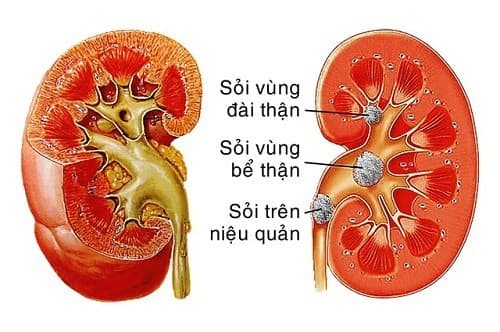 Điều trị sỏi tiết niệu