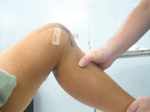 Nếu không được điều trị sớm, đứt dây chằng chéo trước sẽ ảnh hưởng tới sinh hoạt và gây biến chứng