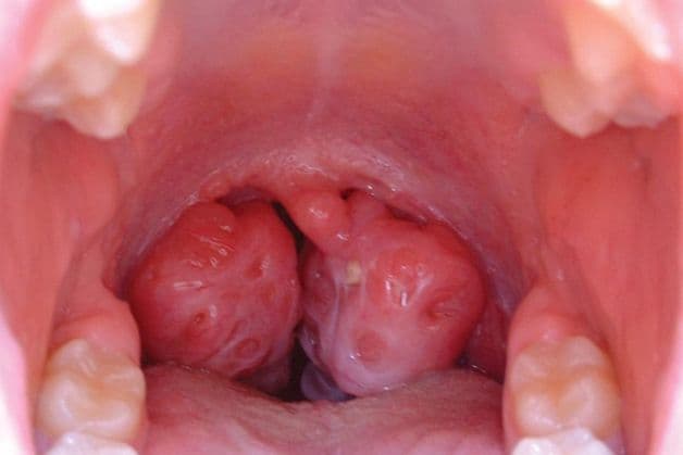 Tìm hiểu cách làm giảm đau amidan