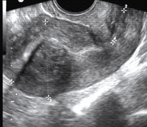  U xơ cơ tử cung trong cơ, u giảm âm do thành phần cơ nhiều hơn xơ trong u