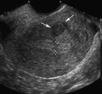 U xơ cơ tử cung dưới niêm mạc lâm sàng thường gây rong kinh, rong huyết