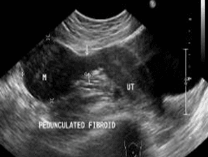 U xơ tử cung có cuống