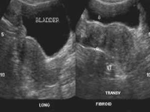 U xơ tử cung dây chằng rộng