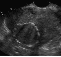 U xơ tử cung bị vôi hóa 