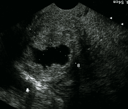 U xơ tử cung bị thoái hóa 