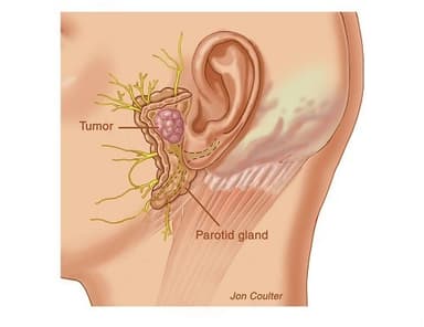 Khái quát về u tuyến nước bọt là lành tính không phải ung thư
