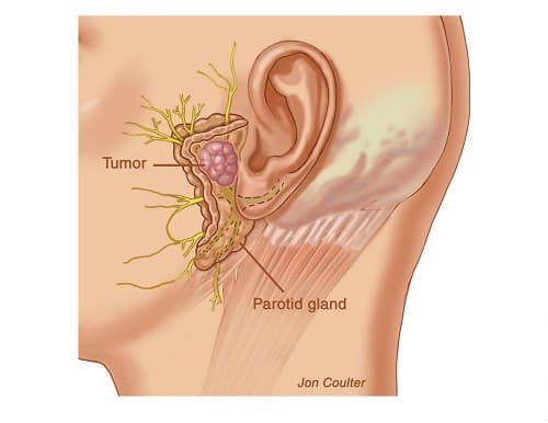 Khái quát về u tuyến nước bọt là lành tính không phải ung thư