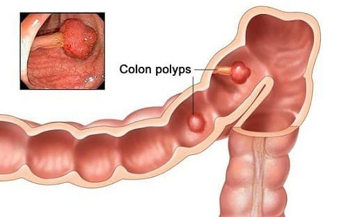 Nội soi đại tràng giúp phát hiện sớm các bệnh lý tiềm ẩn trong lòng đại tràng để kịp thời điều trị sớm