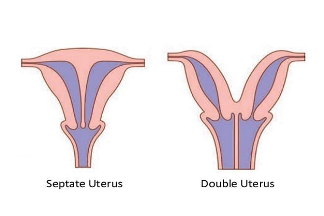Tử cung có vách ngăn nghĩa là khoảng trống trong lòng tử cung bị ngăn bởi một vách ngăn khiến cho diện tích lòng tử cung thu hẹp lại