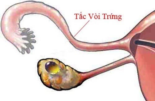 Tắc vòi trứng do nhiều nguyên nhân gây ra như viêm nhiễm, quan hệ tình dục không an toàn...