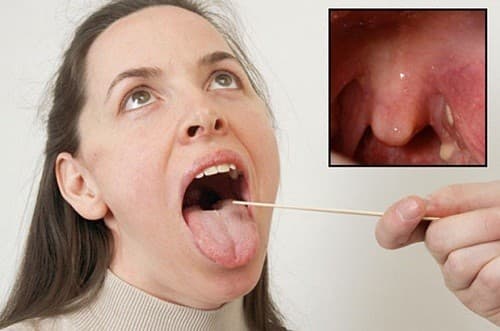 Khi bị viêm amidan cấp tính, người bệnh sẽ có triệu chứng khô, đau, rát ở cổ họng, đau tăng khi nuốt...