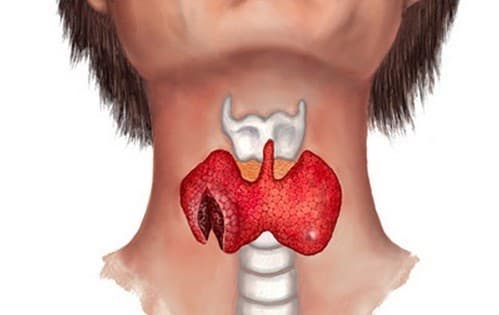  U nang tuyến giáp có nguy hiểm không?