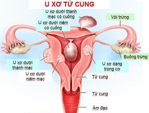 U xơ tử cung là gì?