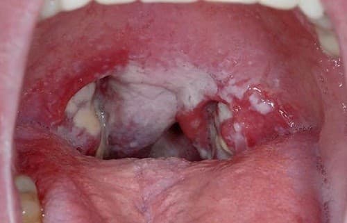 viem-amidan-hoc-mu-la-gi