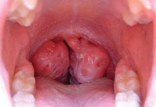 viem-amidan-man-tinh