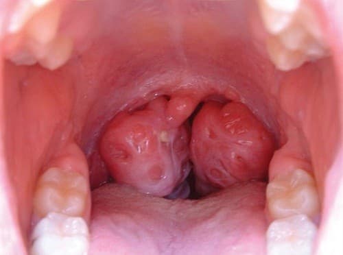 Áp-xe quanh amidan là hiện tượng viêm tấy, hóa mủ tổ chức liên kết lỏng lẻo nằm quanh amidan - giữa amidan và thành bên họng.